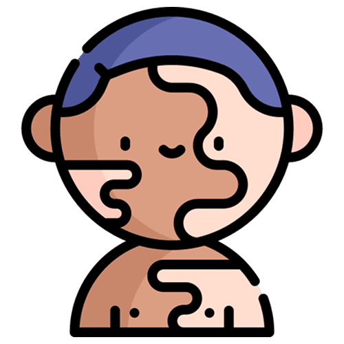 Vitiligo